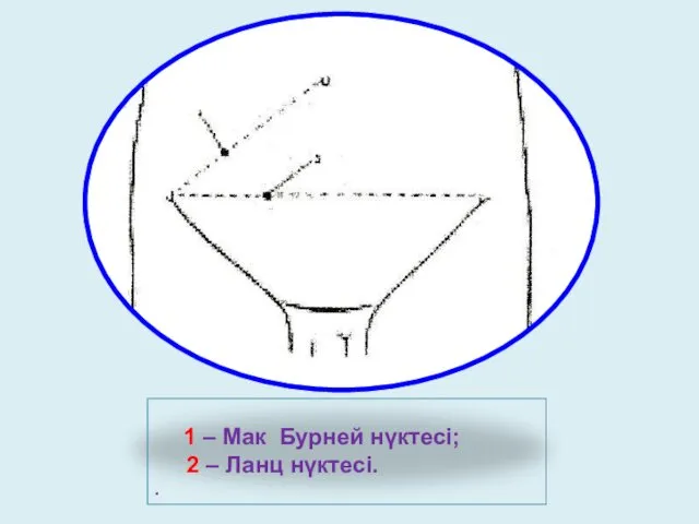 1 – Мак Бурней нүктесі; 2 – Ланц нүктесі. .