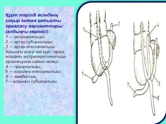 Құрт тәрізді өсіндінің соқыр ішекке қатысты орналасу варианттары: (алдыңғы көрінісі): 1