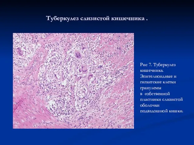 Туберкулез слизистой кишечника . Рис 7. Туберкулез кишечника. Эпителиоидные и гигантские