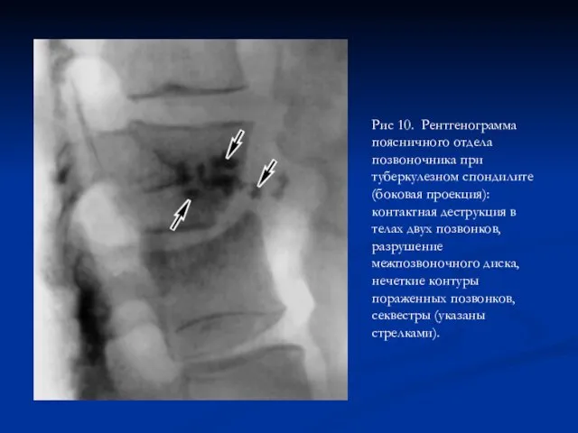 Рис 10. Рентгенограмма поясничного отдела позвоночника при туберкулезном спондилите (боковая проекция):