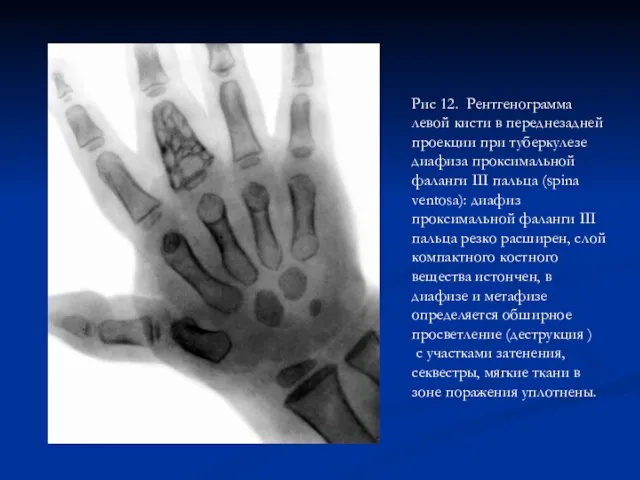 Рис 12. Рентгенограмма левой кисти в переднезадней проекции при туберкулезе диафиза