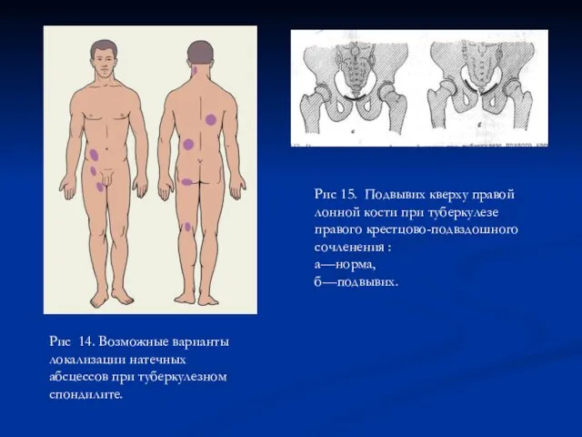 Рис 14. Возможные варианты локализации натечных абсцессов при туберкулезном спондилите. Рис