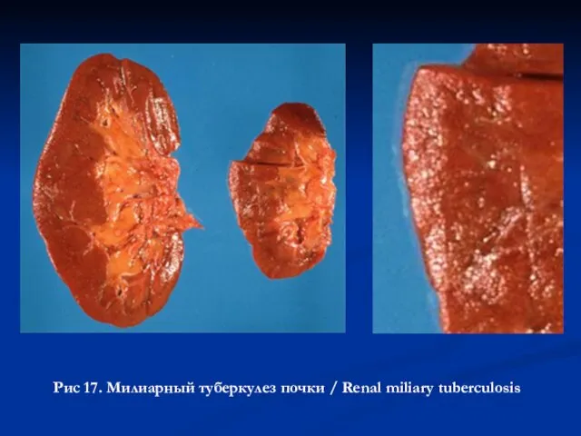 Рис 17. Милиарный туберкулез почки / Renal miliary tuberculosis