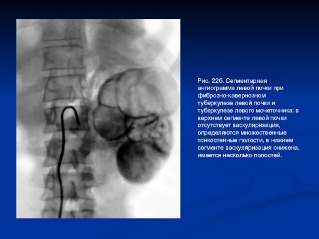 Рис. 22б. Сегментарная ангиограмма левой почки при фиброзно-кавернозном туберкулезе левой почки