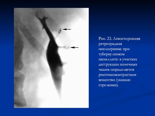 Рис. 23. Левосторонняя ретроградная пиелограмма при туберкулезном папиллите: в участках деструкции