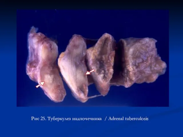 Рис 25. Туберкулез надпочечника / Adrenal tuberculosis