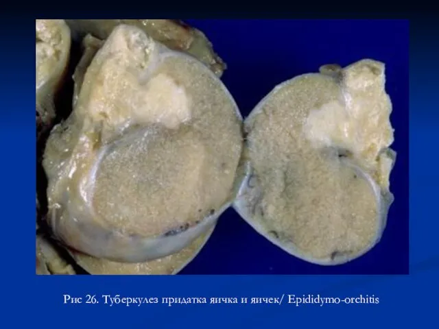 Рис 26. Туберкулез придатка яичка и яичек/ Epididymo-orchitis