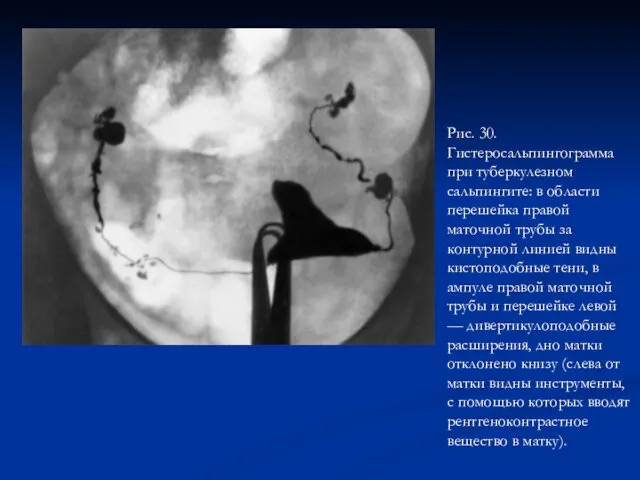 Рис. 30. Гистеросальпингограмма при туберкулезном сальпингите: в области перешейка правой маточной