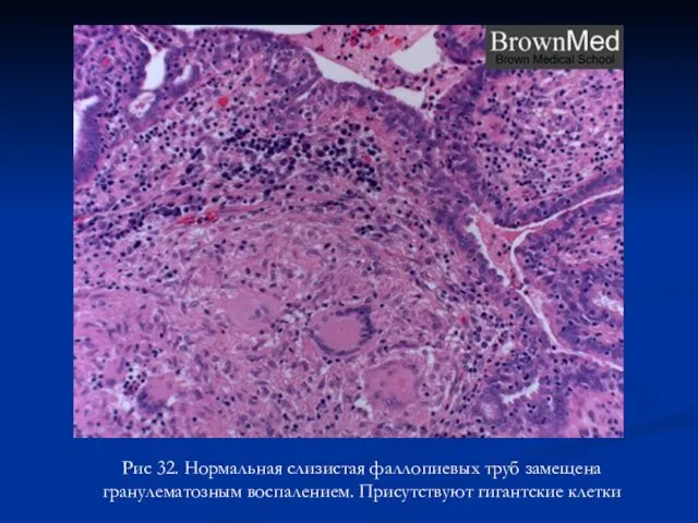 Рис 32. Нормальная слизистая фаллопиевых труб замещена гранулематозным воспалением. Присутствуют гигантские клетки