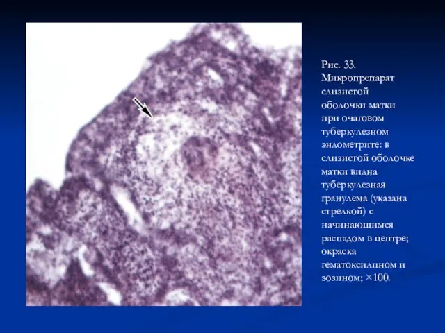 Рис. 33. Микропрепарат слизистой оболочки матки при очаговом туберкулезном эндометрите: в