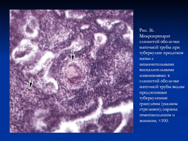 Рис. 36. Микропрепарат слизистой оболочки маточной трубы при туберкулезе придатков матки