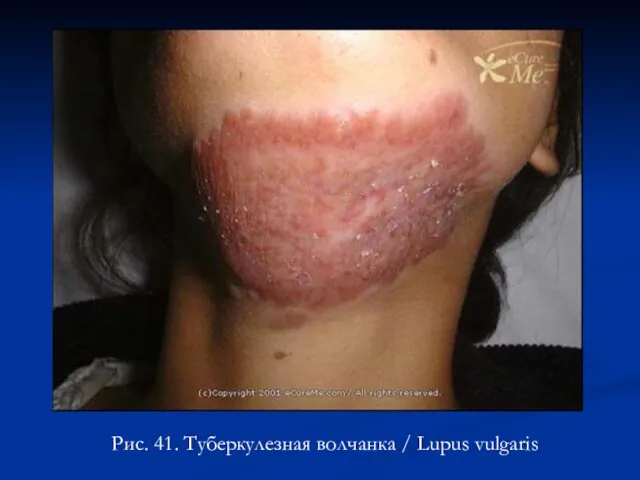 Рис. 41. Туберкулезная волчанка / Lupus vulgaris