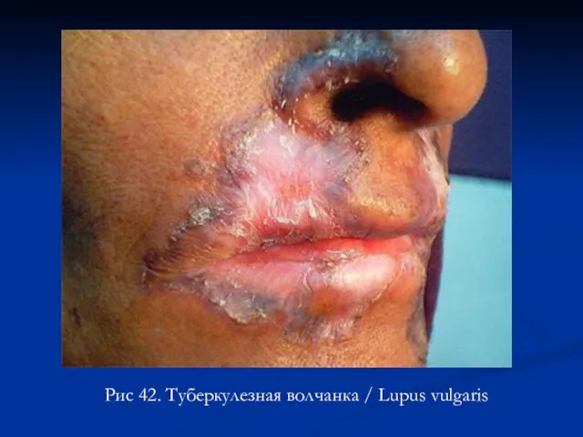 Рис 42. Туберкулезная волчанка / Lupus vulgaris