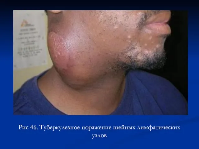 Рис 46. Туберкулезное поражение шейных лимфатических узлов
