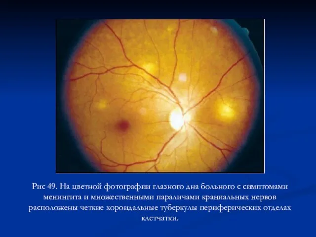 Рис 49. На цветной фотографии глазного дна больного с симптомами менингита