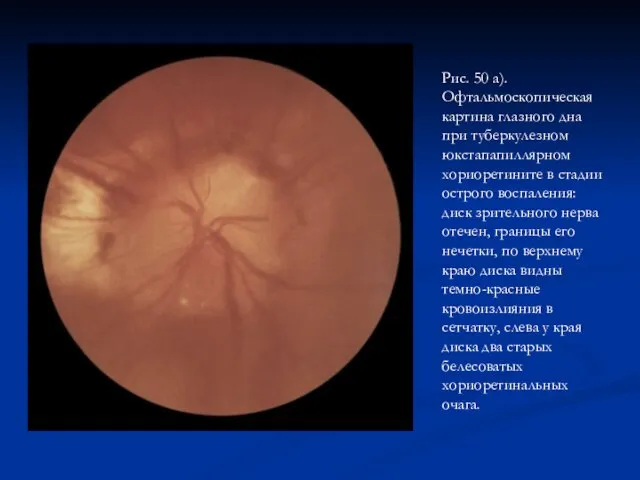 Рис. 50 а). Офтальмоскопическая картина глазного дна при туберкулезном юкстапапиллярном хориоретините