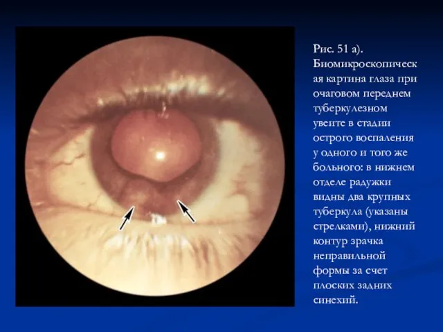 Рис. 51 а). Биомикроскопическая картина глаза при очаговом переднем туберкулезном увеите