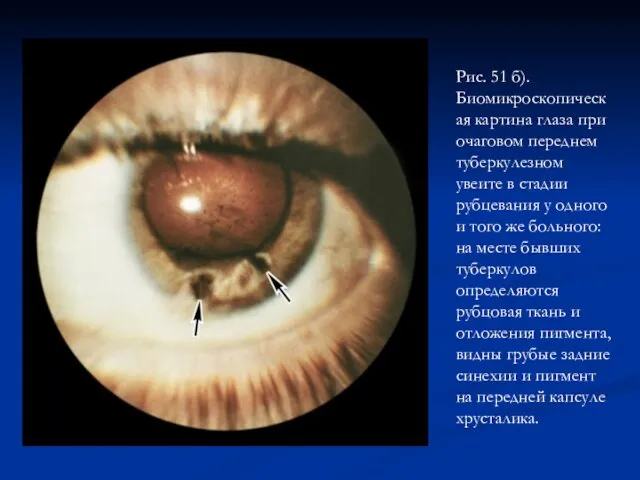 Рис. 51 б). Биомикроскопическая картина глаза при очаговом переднем туберкулезном увеите