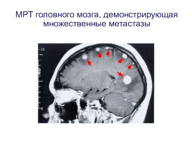 МРТ головного мозга, демонстрирующая множественные метастазы