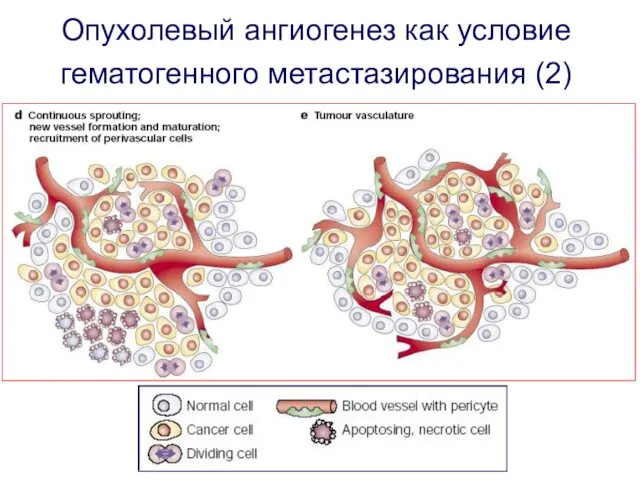 Опухолевый ангиогенез как условие гематогенного метастазирования (2)