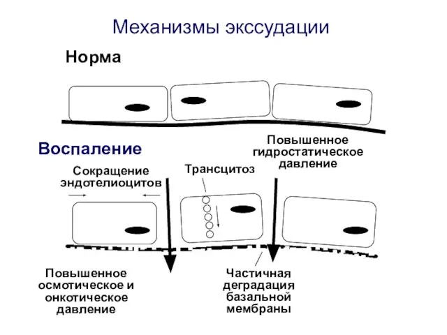 Норма Воспаление Механизмы экссудации Сокращение эндотелиоцитов Трансцитоз Частичная деградация базальной мембраны