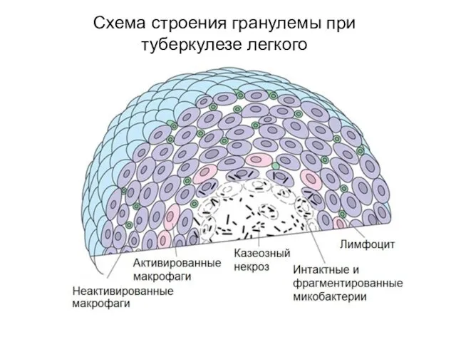 Схема строения гранулемы при туберкулезе легкого