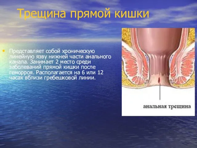 Трещина прямой кишки Представляет собой хроническую линейную язву нижней части анального