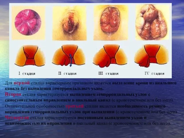 Для первой стадии характерным признаком является выделение крови из анального канала