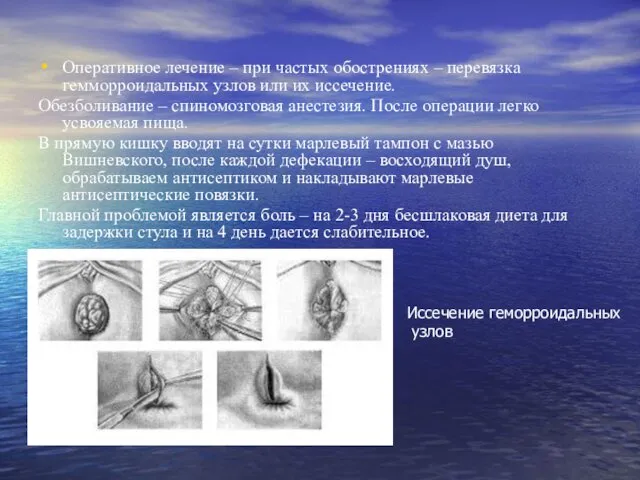 Оперативное лечение – при частых обострениях – перевязка гемморроидальных узлов или