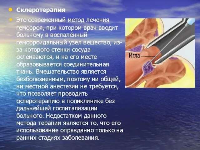 Склеротерапия Это современный метод лечения геморроя, при котором врач вводит больному