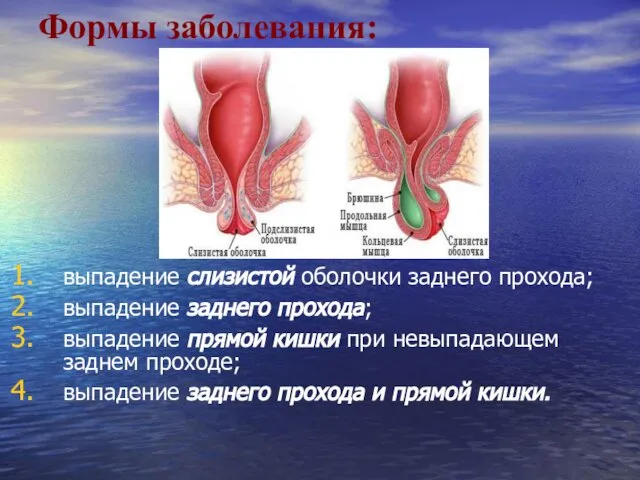 Формы заболевания: выпадение слизистой оболочки заднего прохода; выпадение заднего прохода; выпадение