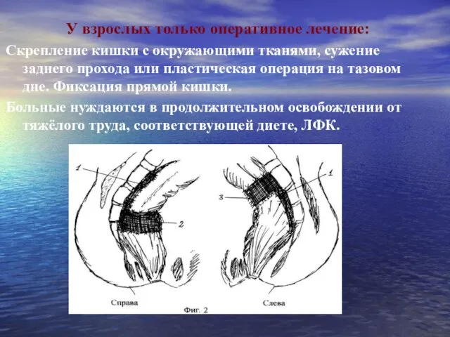 У взрослых только оперативное лечение: Скрепление кишки с окружающими тканями, сужение