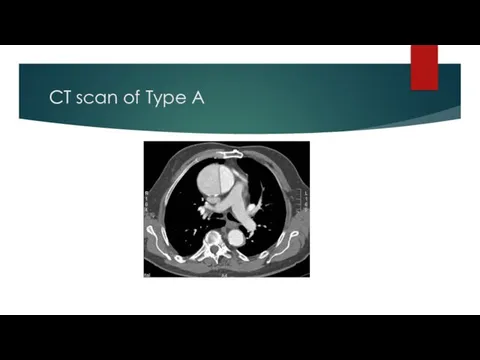 CT scan of Type A