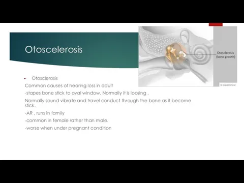 Otoscelerosis Otosclerosis Common causes of hearing loss in adult -stapes bone