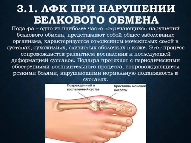 3.1. ЛФК ПРИ НАРУШЕНИИ БЕЛКОВОГО ОБМЕНА Подагра – одно из наиболее