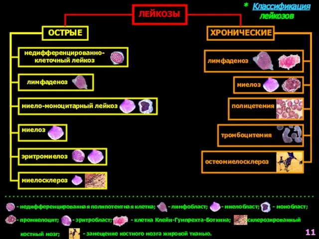 * Классификация лейкозов ЛЕЙКОЗЫ ОСТРЫЕ ХРОНИЧЕСКИЕ недифференцированно- клеточный лейкоз лимфаденоз лимфаденоз