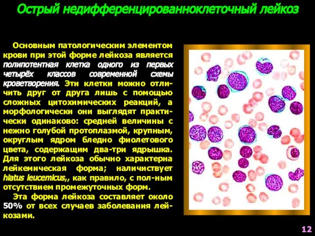 Острый недифференцированноклеточный лейкоз Основным патологическим элементом крови при этой форме лейкоза