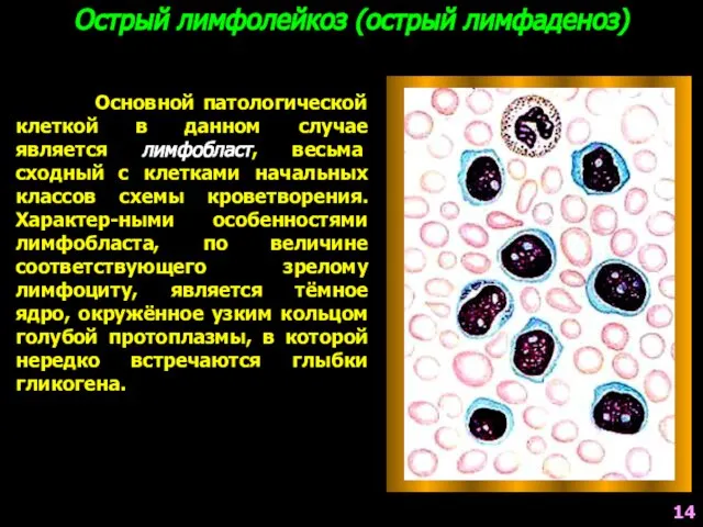 Основной патологической клеткой в данном случае является лимфобласт, весьма сходный с