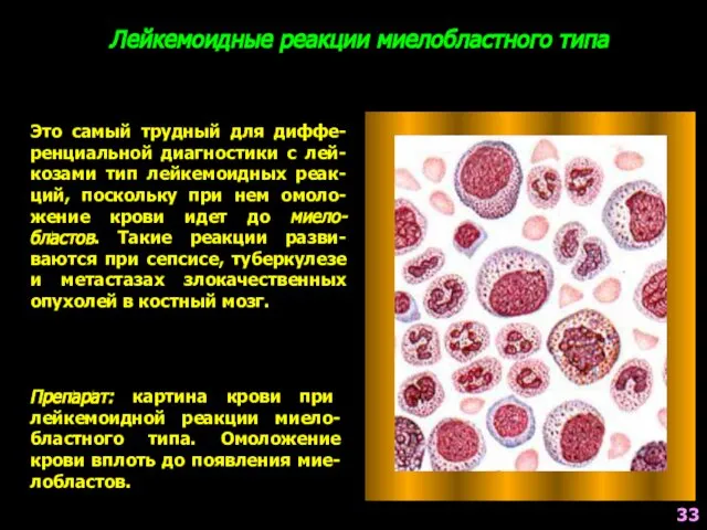 Лейкемоидные реакции миелобластного типа Это самый трудный для диффе-ренциальной диагностики с