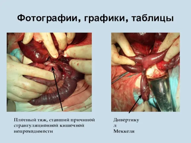 Фотографии, графики, таблицы Дивертикул Меккеля Плотный тяж, ставший причиной странгуляционной кишечной непроходимости