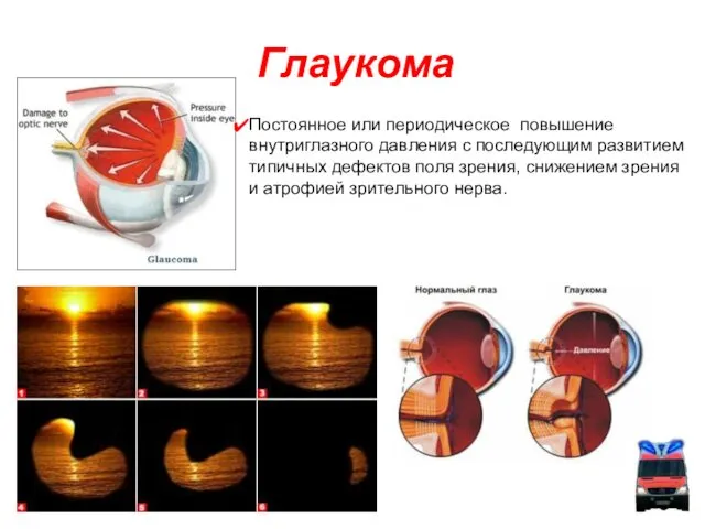 Глаукома Постоянное или периодическое повышение внутриглазного давления с последующим развитием типичных