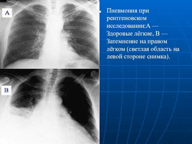 Пневмония при рентгеновском исследовании:А — Здоровые лёгкие, В — Затемнение на