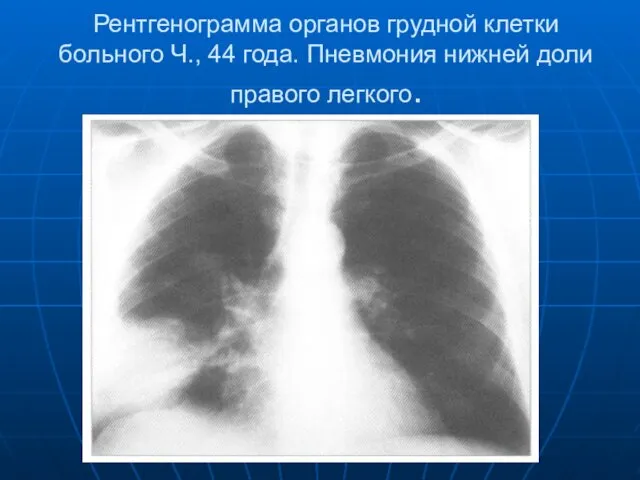 Рентгенограмма органов грудной клетки больного Ч., 44 года. Пневмония нижней доли правого легкого.