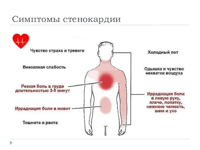 Симптомы стенокардии