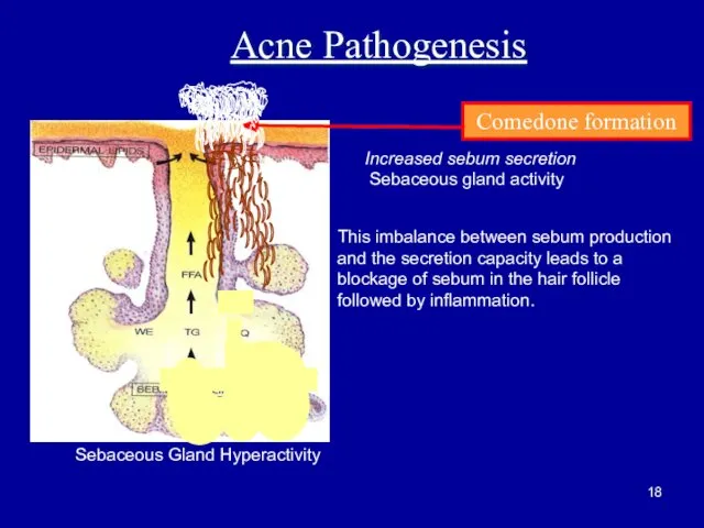 Comedone formation Acne Pathogenesis Increased sebum secretion Sebaceous gland activity Sebaceous