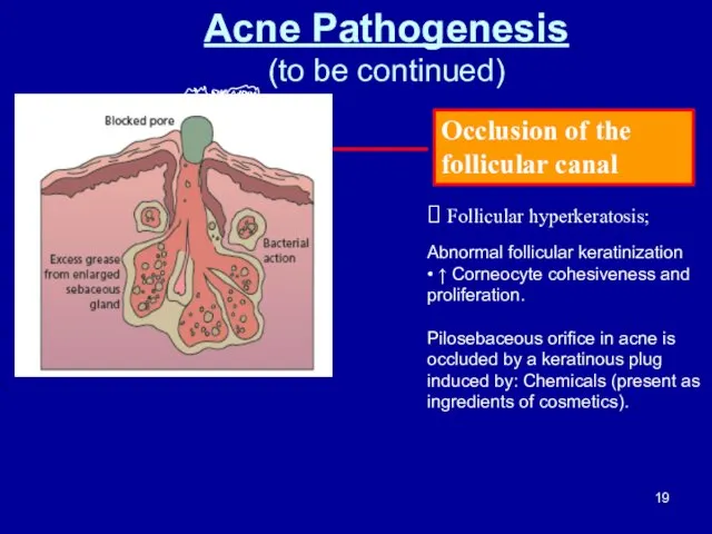 Occlusion of the follicular canal Acne Pathogenesis (to be continued) Follicular