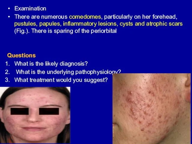 Examination There are numerous comedomes, particularly on her forehead, pustules, papules,