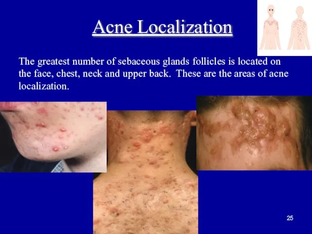 The greatest number of sebaceous glands follicles is located on the
