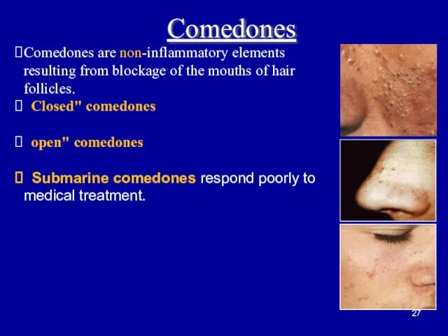 Comedones Comedones are non-inflammatory elements resulting from blockage of the mouths