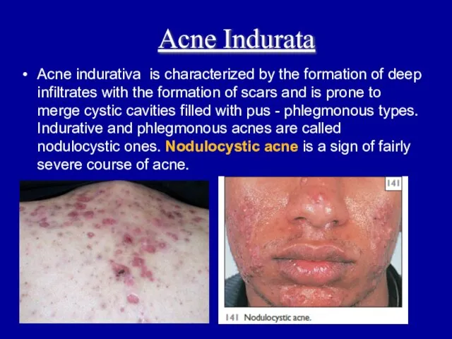Acne indurativa is characterized by the formation of deep infiltrates with